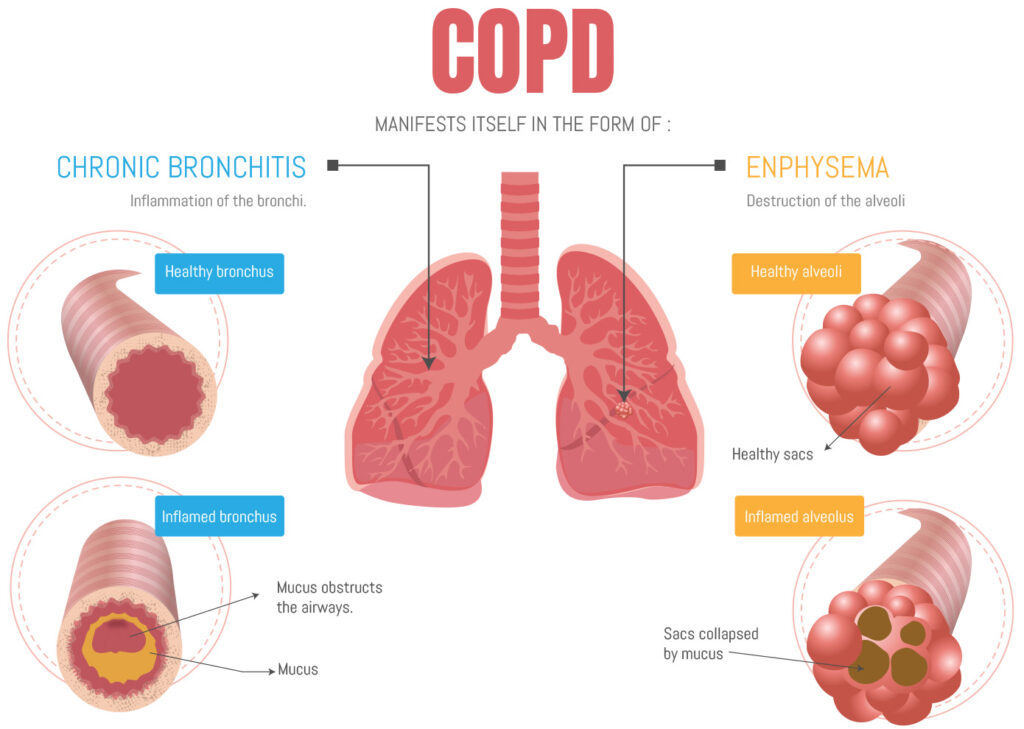 COPD